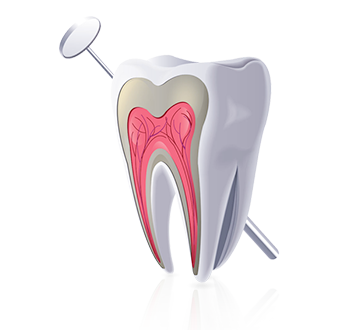 优贝口腔-根管治疗，根治牙痛